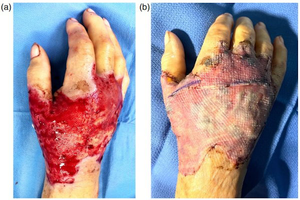 Dorsal right hand following debridement or dead skin and closure of fasciotomy wounds